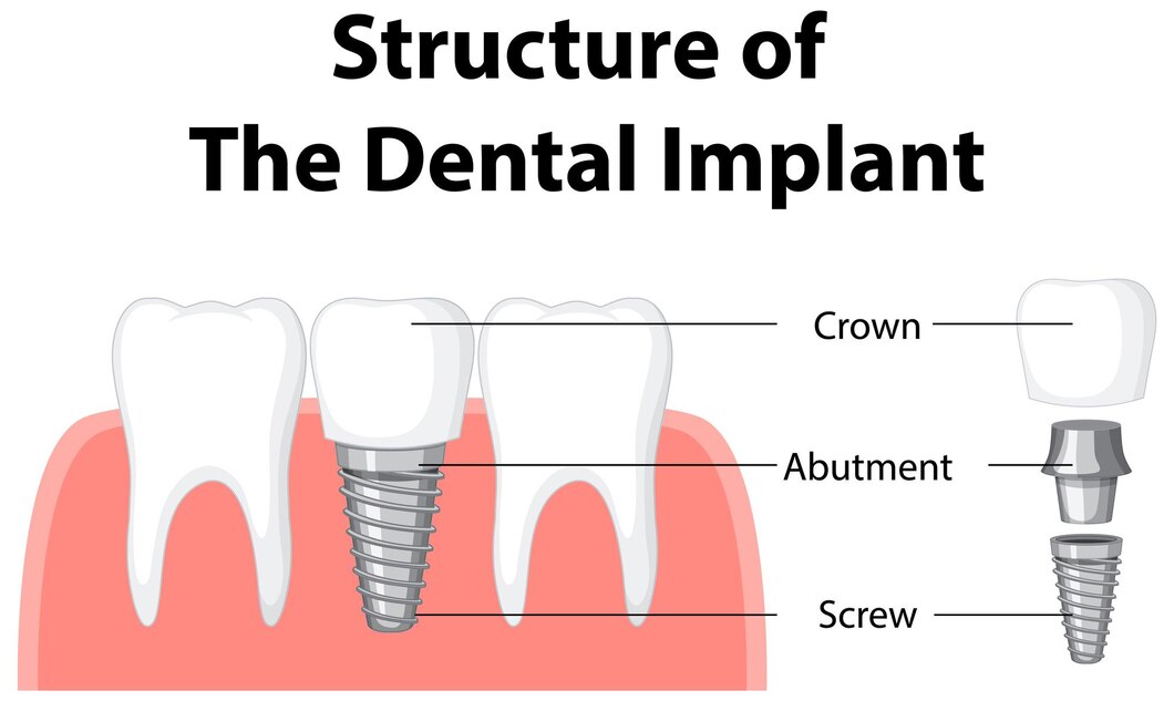 Dental Implants in baner